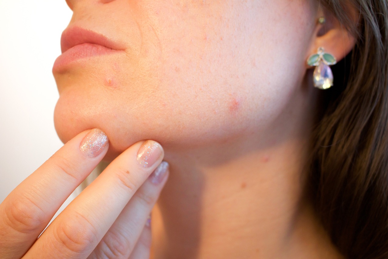 Prevention of Acne
